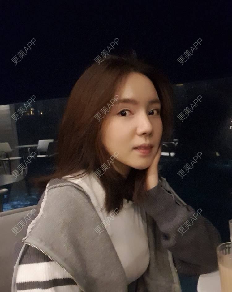 更美 - 律儿的鼻部多项经验 | 宽下巴矫正 | 鼻部多项