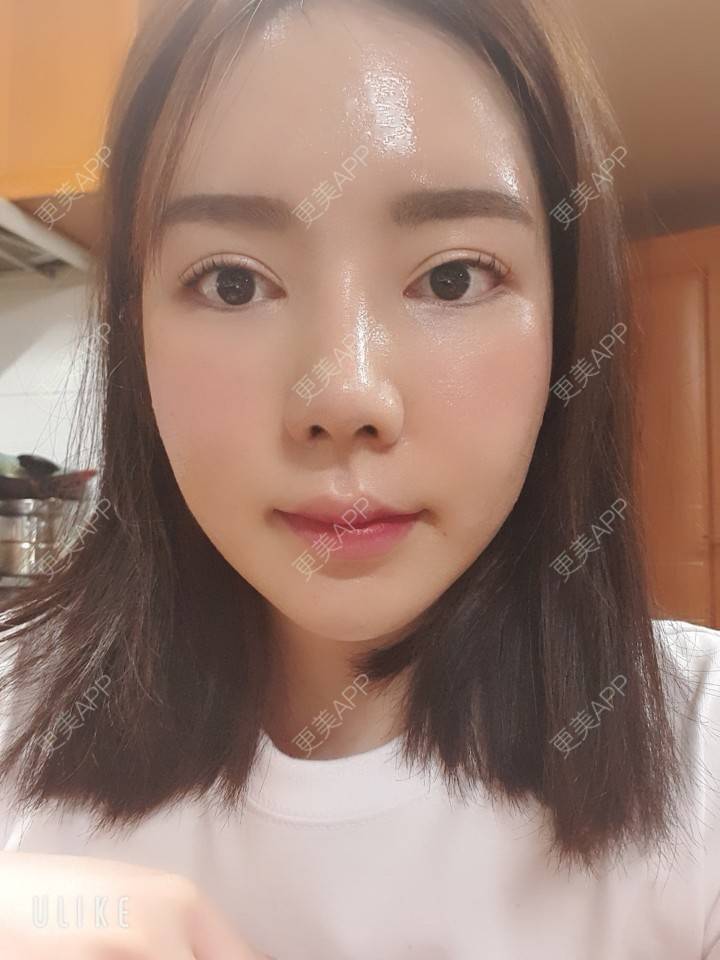 更美 - 律儿的鼻部多项经验 | 宽下巴矫正 | 鼻部多项