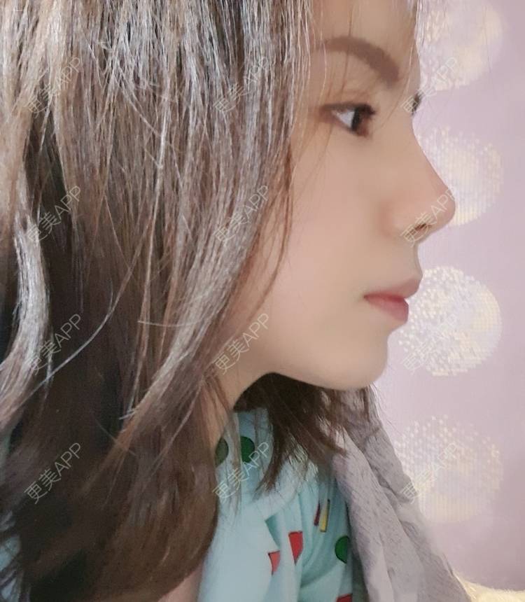 更美 - 律儿的鼻部多项经验 | 宽下巴矫正 | 鼻部多项