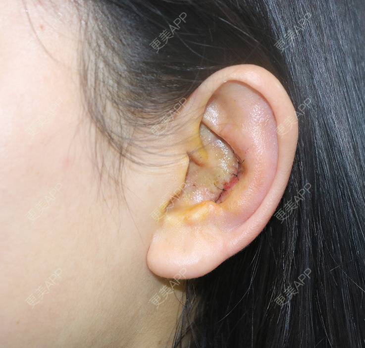 更美用户49gb35ugun的耳软骨隆鼻日记