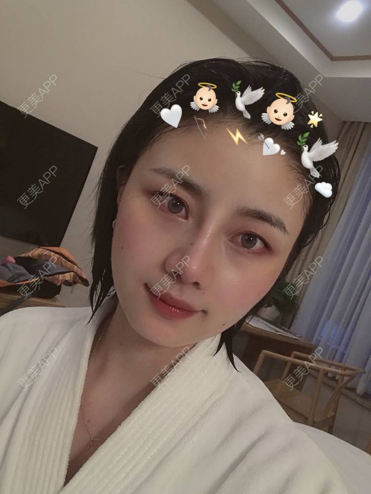 更美 - 更美用户R8DRI4045X的鼻部多项经验 | 成都 | 鼻部多项