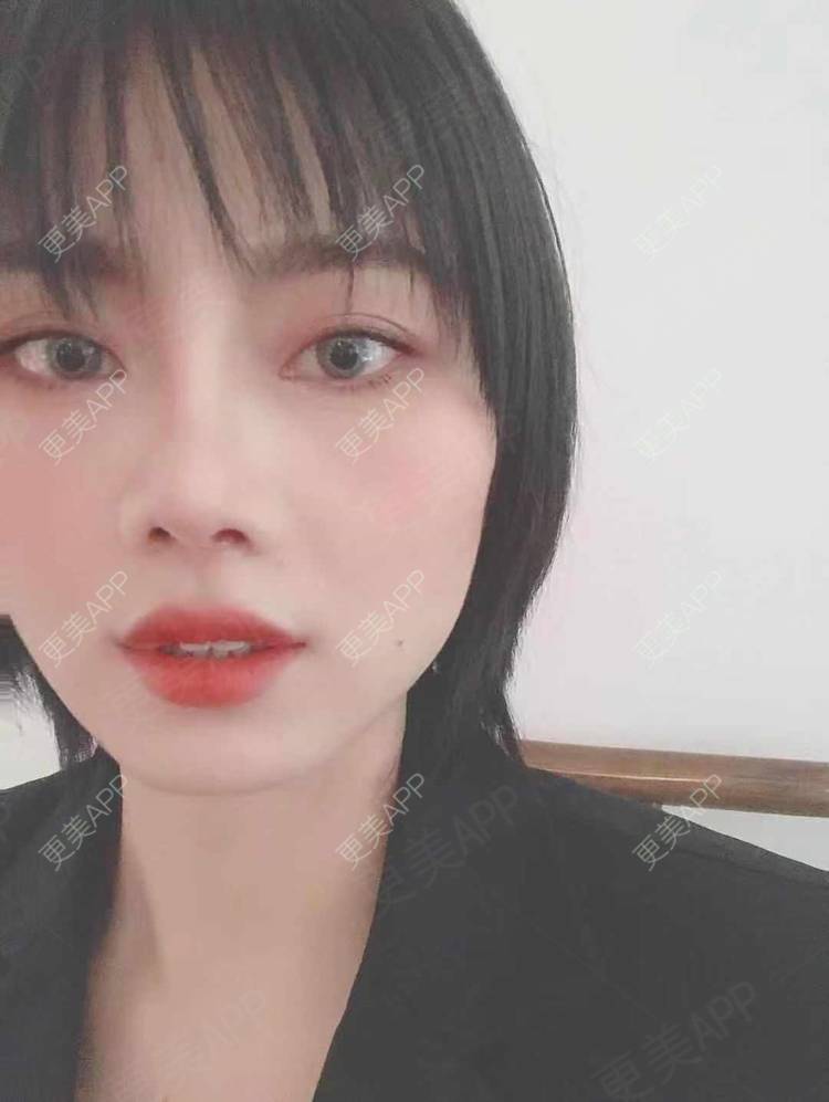 更美 - 更美用户R8DRI4045X的鼻部多项经验 | 成都 | 鼻部多项