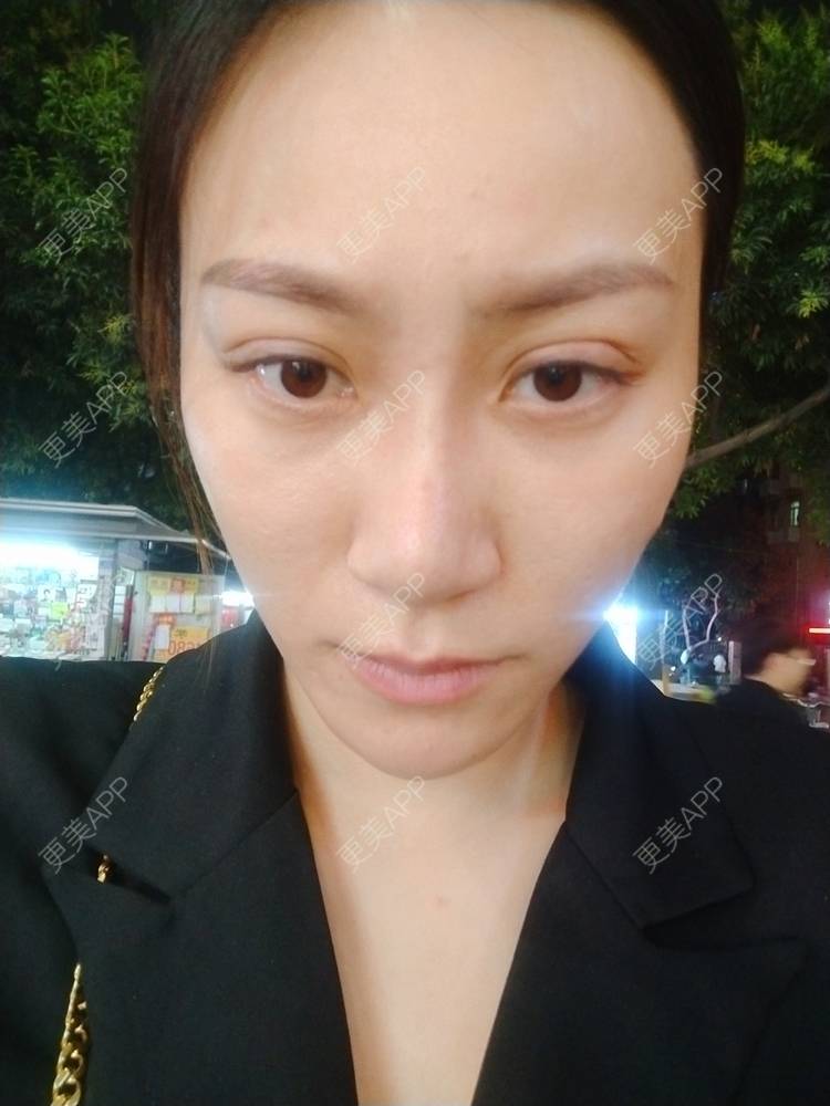更美 - 逗逗是剩女的双眼皮经验 | 全切双眼皮 | 埋线隆鼻 | 广州 | 视频日记