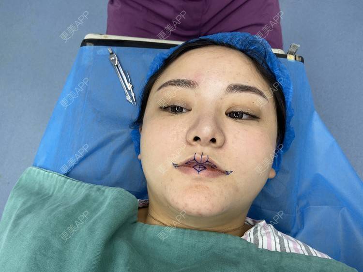 m唇成形术手术_更美用户q96xgum9yom唇成形术手术_更美整形