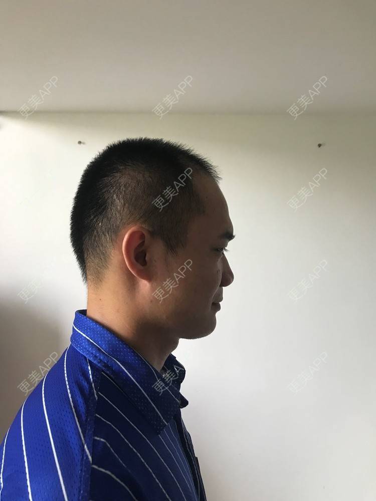 更美 - 更美用户y5O1wsEQkc的鬓角植发经验 | 广州 | 鬓角植发