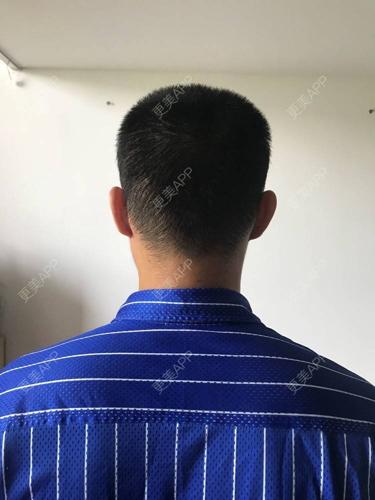 更美 - 更美用户y5O1wsEQkc的鬓角植发经验 | 广州 | 鬓角植发