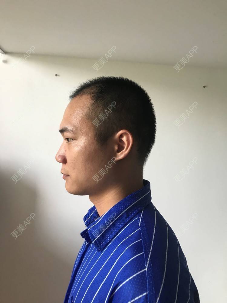 更美 - 更美用户y5O1wsEQkc的鬓角植发经验 | 广州 | 鬓角植发