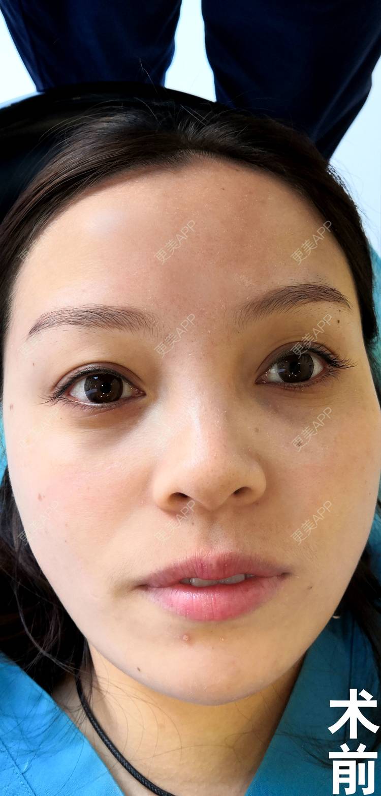 更美 - 更美用户7ERZFuzQiH的胶原蛋白丰泪沟经验 | 胶原蛋白丰泪沟