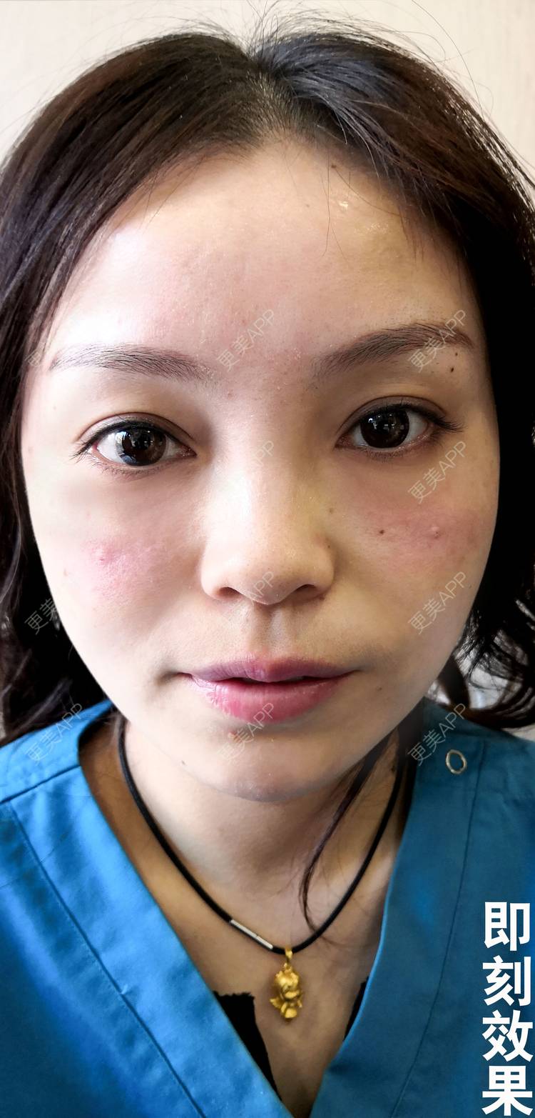 更美 - 更美用户7ERZFuzQiH的胶原蛋白丰泪沟经验 | 胶原蛋白丰泪沟