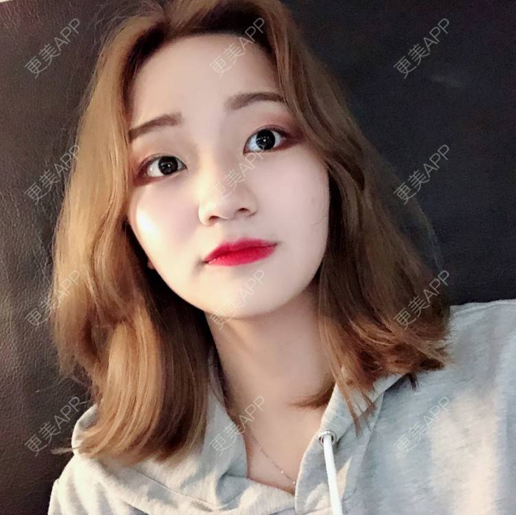 更美 - 宣呀的自体脂肪丰苹果肌经验 | 自体脂肪面部填充 | 自体脂肪丰苹果肌 | 自体脂肪丰面颊 | 武汉 | 自体脂肪全面部填充