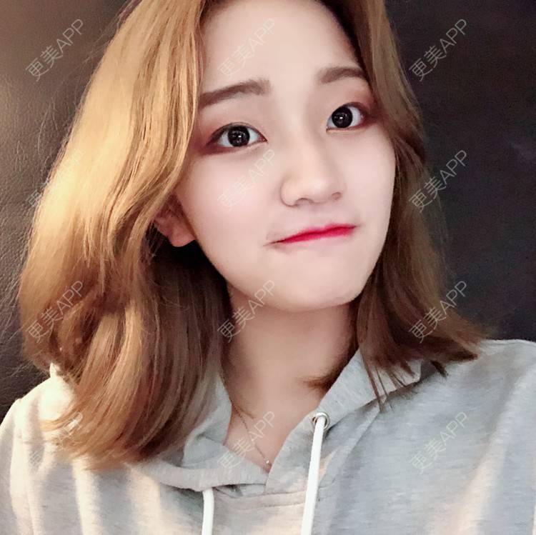 更美 - 宣呀的自体脂肪丰苹果肌经验 | 自体脂肪面部填充 | 自体脂肪丰苹果肌 | 自体脂肪丰面颊 | 武汉 | 自体脂肪全面部填充