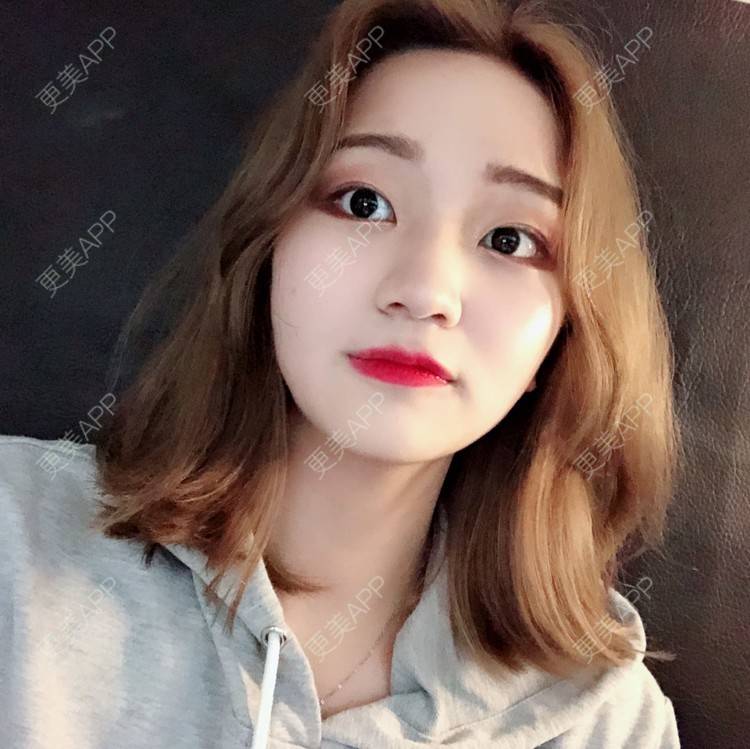 更美 - 宣呀的自体脂肪丰苹果肌经验 | 自体脂肪面部填充 | 自体脂肪丰苹果肌 | 自体脂肪丰面颊 | 武汉 | 自体脂肪全面部填充