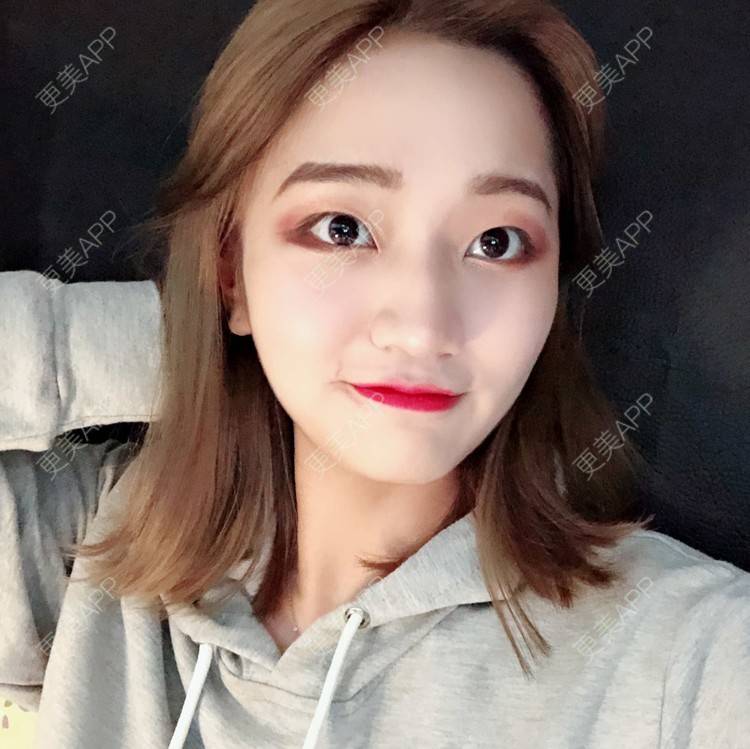 更美 - 宣呀的自体脂肪丰苹果肌经验 | 自体脂肪面部填充 | 自体脂肪丰苹果肌 | 自体脂肪丰面颊 | 武汉 | 自体脂肪全面部填充