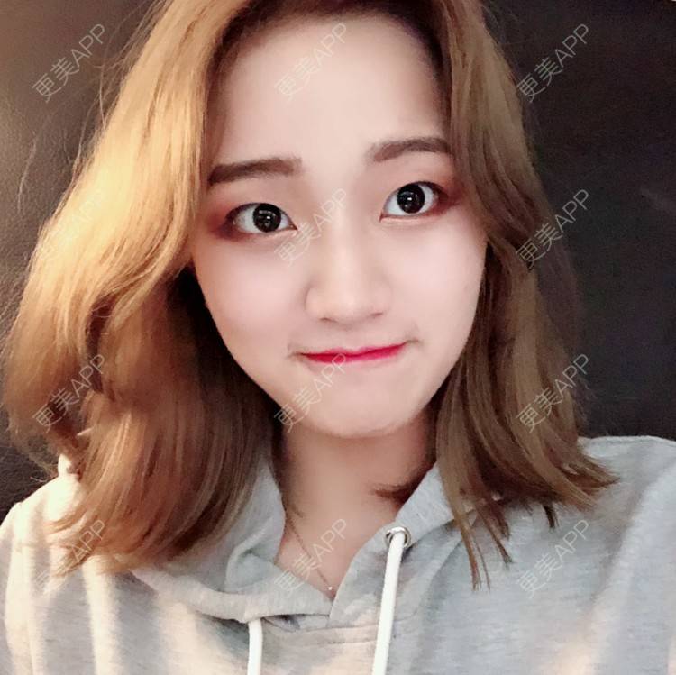 更美 - 宣呀的自体脂肪丰苹果肌经验 | 自体脂肪面部填充 | 自体脂肪丰苹果肌 | 自体脂肪丰面颊 | 武汉 | 自体脂肪全面部填充
