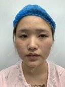 更美 - 变美找我~的肋软骨隆鼻经验 | 耳软骨隆鼻 | 鼻翼缩小 | 眼部多项 | 自体脂肪全面部填充 | 肋软骨隆鼻 | 宁波 | 鼻孔矫正 | 自体肋软骨垫鼻基底