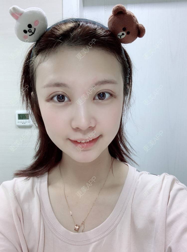 豆子逗的全切双眼皮日记