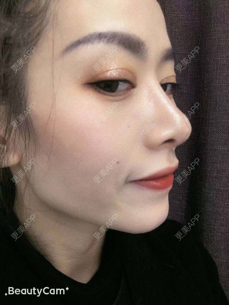 更美 - 进击的露露的隆鼻经验 | 隆鼻 | 鼻部多项 | 硅胶垫下巴 | 膨体隆鼻 | 重庆 | 鼻中隔软骨隆鼻 | 耳软骨隆鼻