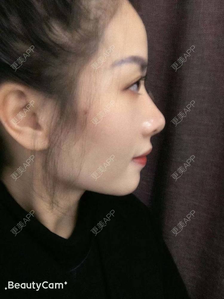 更美 - 进击的露露的隆鼻经验 | 隆鼻 | 鼻部多项 | 硅胶垫下巴 | 膨体隆鼻 | 重庆 | 鼻中隔软骨隆鼻 | 耳软骨隆鼻