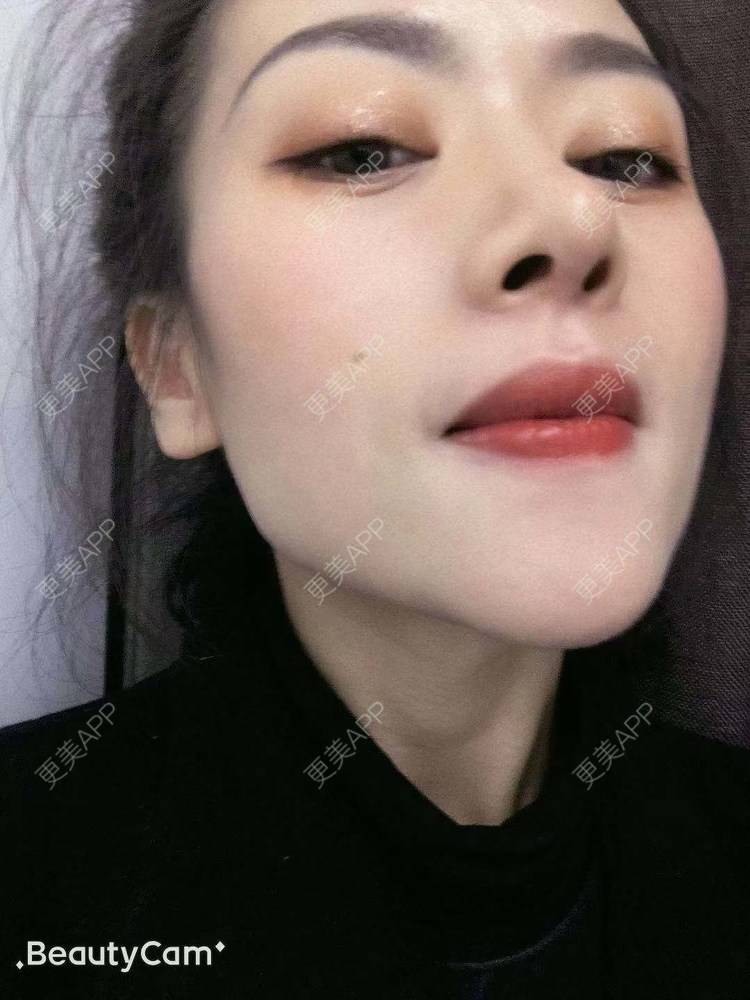 更美 - 进击的露露的隆鼻经验 | 隆鼻 | 鼻部多项 | 硅胶垫下巴 | 膨体隆鼻 | 重庆 | 鼻中隔软骨隆鼻 | 耳软骨隆鼻
