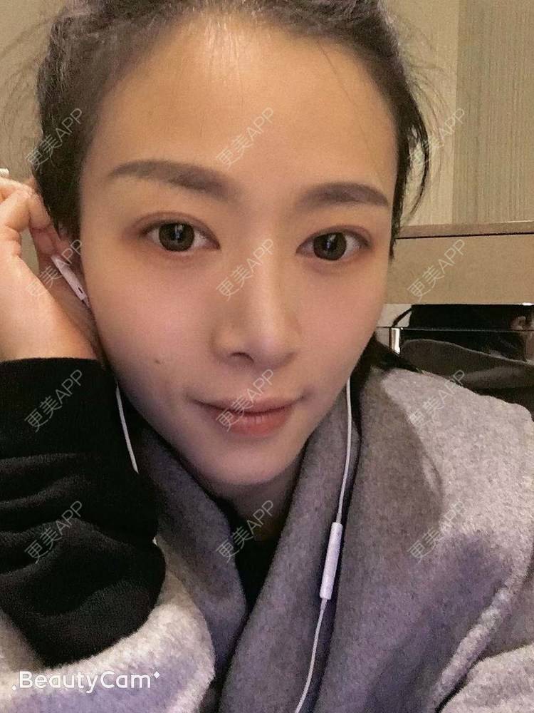 更美 - 进击的露露的隆鼻经验 | 隆鼻 | 鼻部多项 | 硅胶垫下巴 | 膨体隆鼻 | 重庆 | 鼻中隔软骨隆鼻 | 耳软骨隆鼻