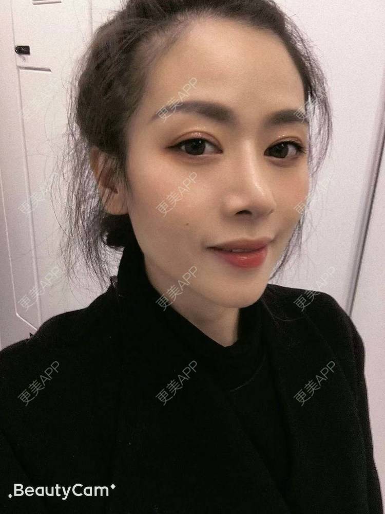 更美 - 进击的露露的隆鼻经验 | 隆鼻 | 鼻部多项 | 硅胶垫下巴 | 膨体隆鼻 | 重庆 | 鼻中隔软骨隆鼻 | 耳软骨隆鼻