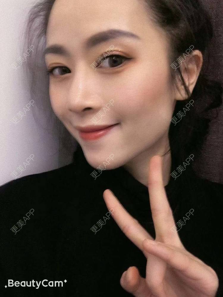 更美 - 进击的露露的隆鼻经验 | 隆鼻 | 鼻部多项 | 硅胶垫下巴 | 膨体隆鼻 | 重庆 | 鼻中隔软骨隆鼻 | 耳软骨隆鼻