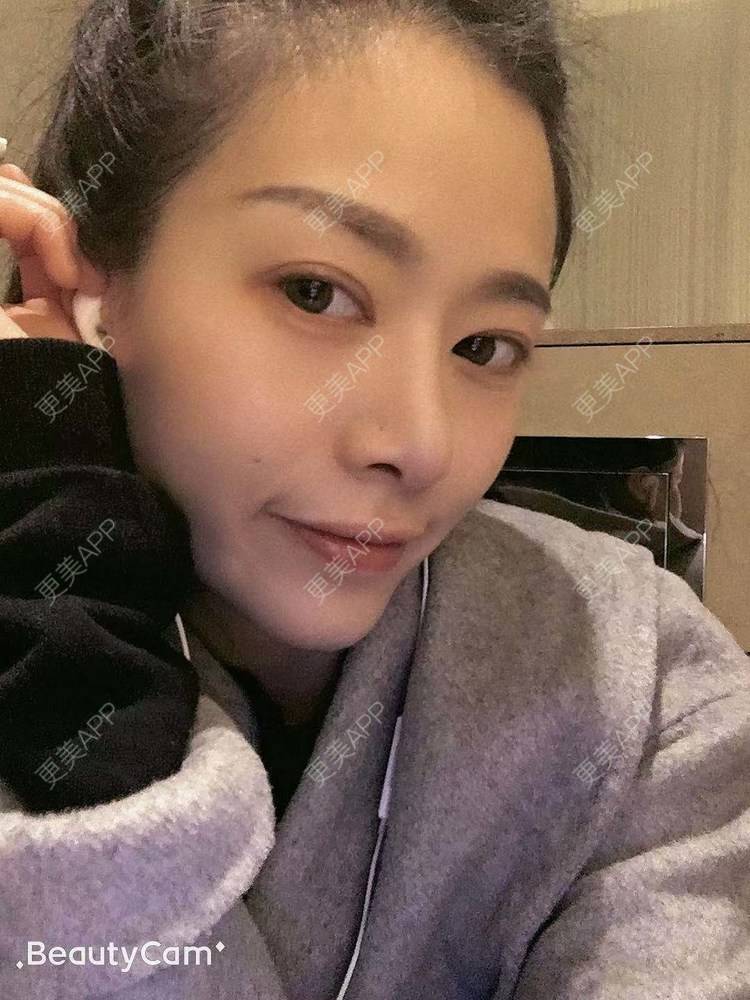更美 - 进击的露露的隆鼻经验 | 隆鼻 | 鼻部多项 | 硅胶垫下巴 | 膨体隆鼻 | 重庆 | 鼻中隔软骨隆鼻 | 耳软骨隆鼻