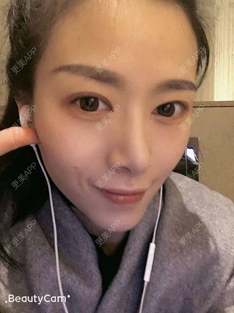更美 - 进击的露露的隆鼻经验 | 隆鼻 | 鼻部多项 | 硅胶垫下巴 | 膨体隆鼻 | 重庆 | 鼻中隔软骨隆鼻 | 耳软骨隆鼻