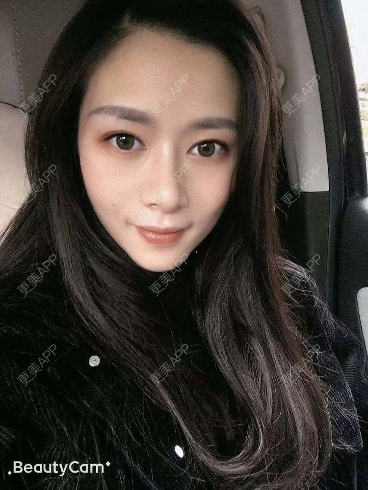 更美 - 进击的露露的隆鼻经验 | 隆鼻 | 鼻部多项 | 硅胶垫下巴 | 膨体隆鼻 | 重庆 | 鼻中隔软骨隆鼻 | 耳软骨隆鼻