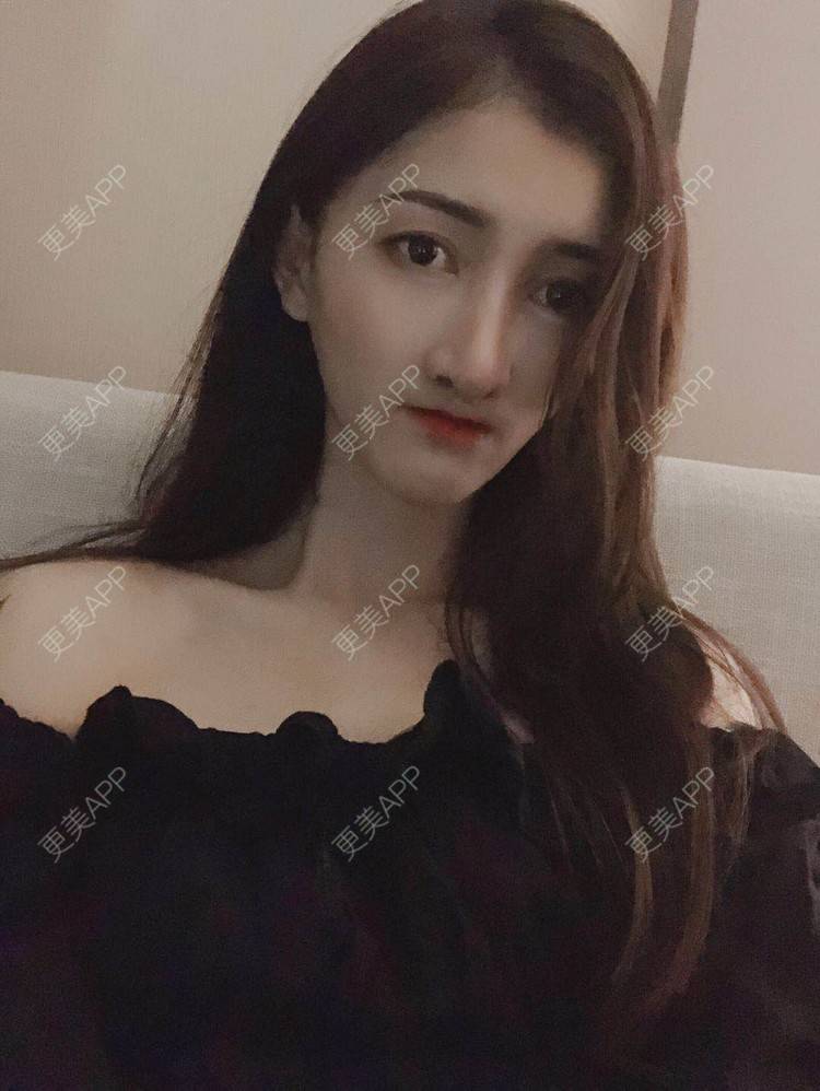 更美 - 最美的期待i的鼻形态修复经验 | 广州 | 鼻形态修复