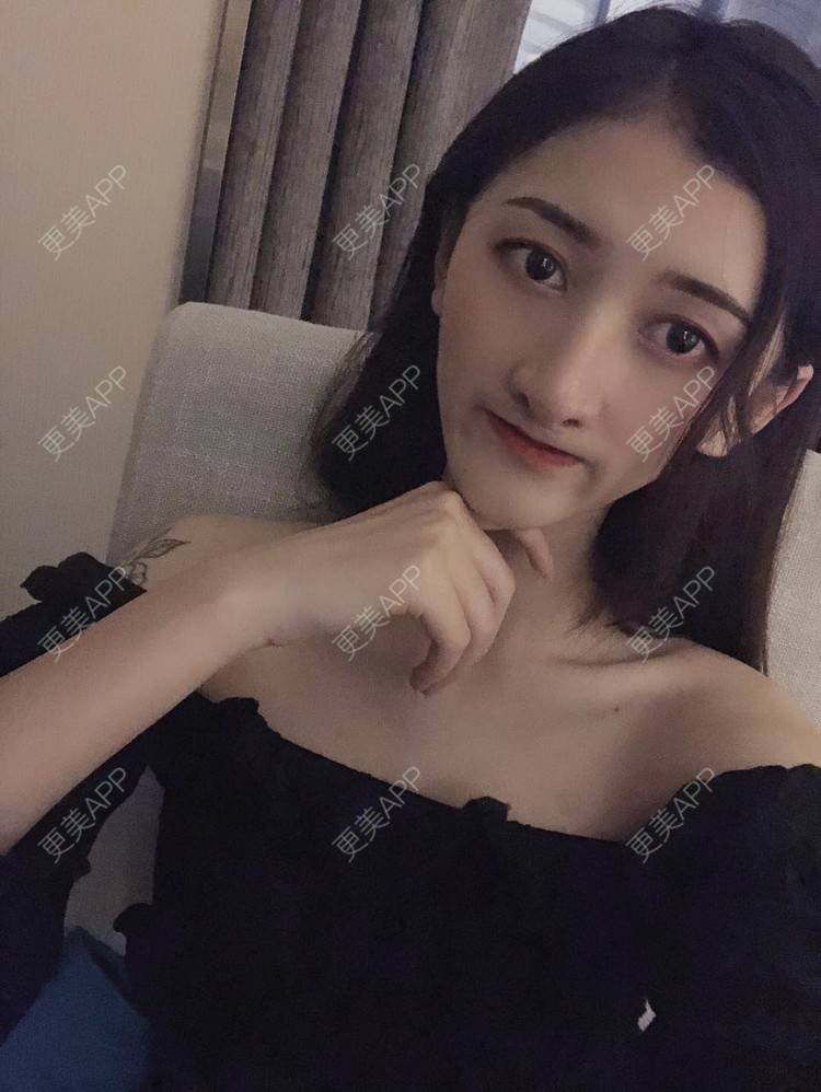 更美 - 最美的期待i的鼻形态修复经验 | 广州 | 鼻形态修复