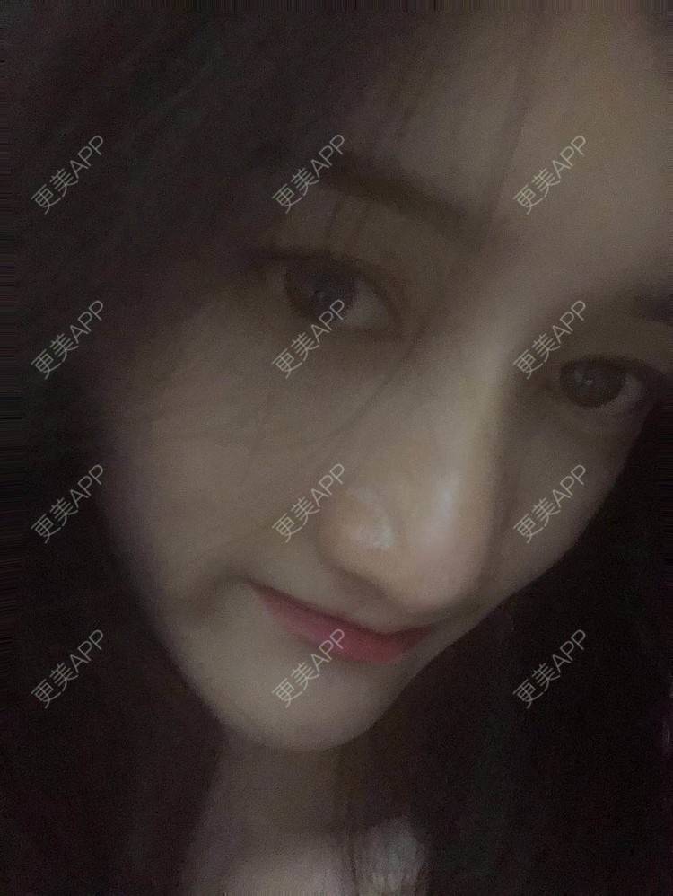 更美 - 最美的期待i的鼻形态修复经验 | 广州 | 鼻形态修复