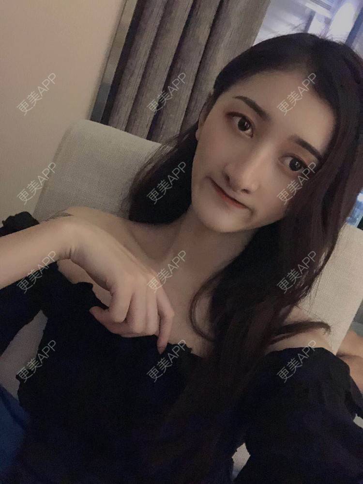 更美 - 最美的期待i的鼻形态修复经验 | 广州 | 鼻形态修复