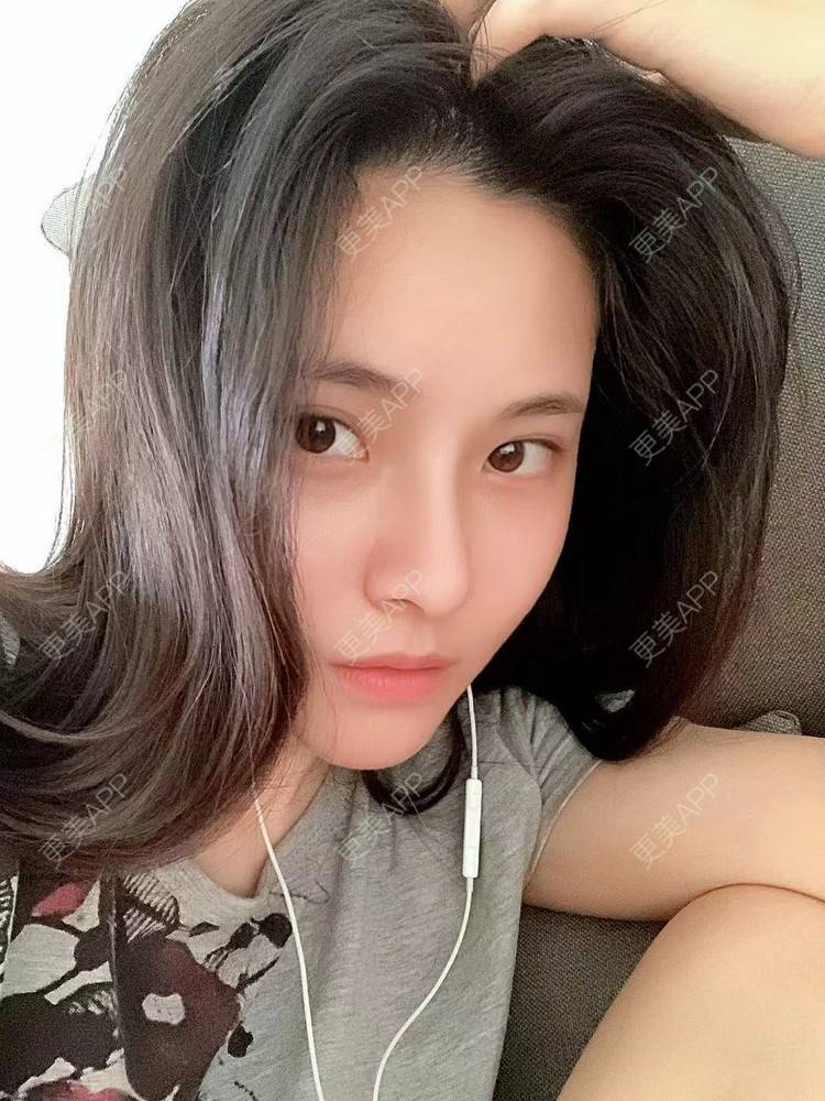 更美 - 大美人图的自体脂肪丰额头经验 | 更美研究所 | 杭州 | 下巴 | 自体脂肪丰额头