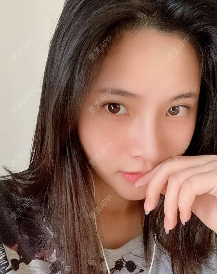 更美 - 大美人图的自体脂肪丰额头经验 | 更美研究所 | 杭州 | 下巴 | 自体脂肪丰额头
