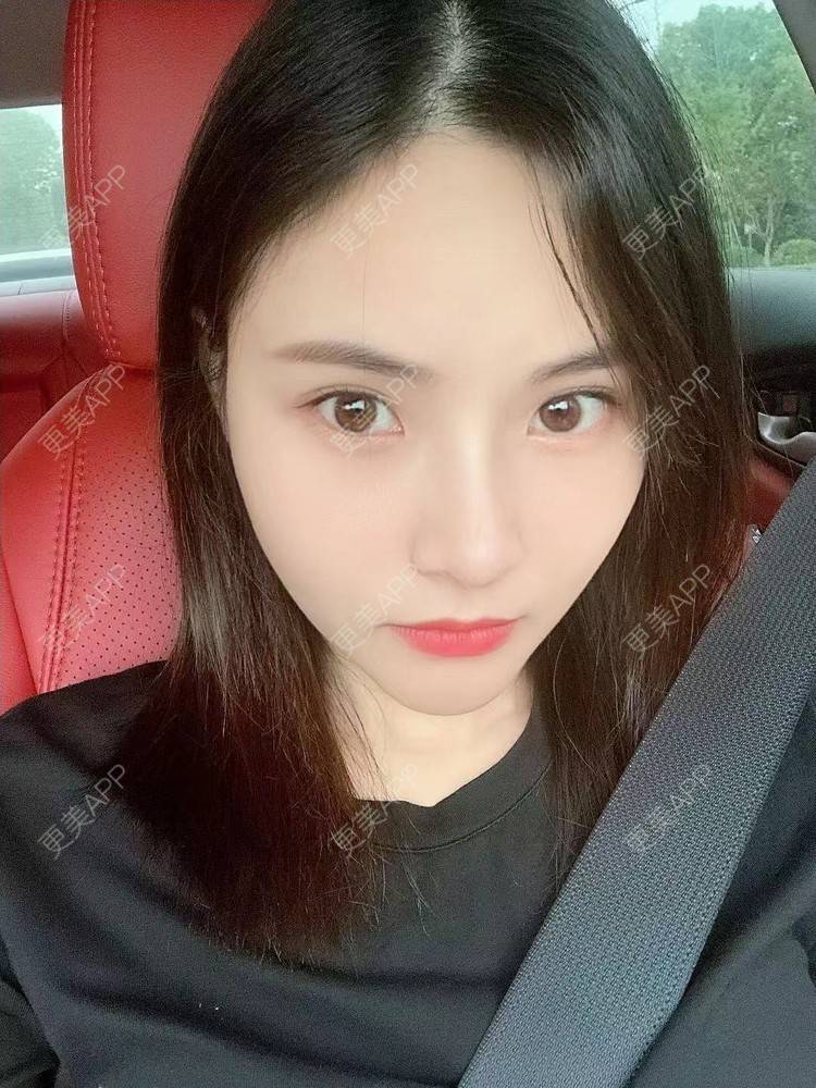 更美 - 大美人图的自体脂肪丰额头经验 | 更美研究所 | 杭州 | 下巴 | 自体脂肪丰额头