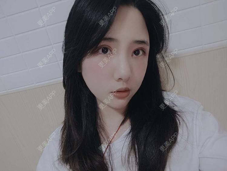 更美 - 更美用户R2vuT1w108的双眼皮修复经验 | 广州 | 双眼皮修复