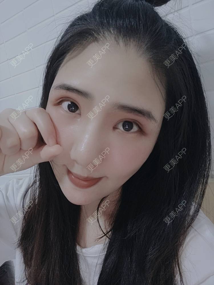 更美 - 更美用户R2vuT1w108的双眼皮修复经验 | 广州 | 双眼皮修复