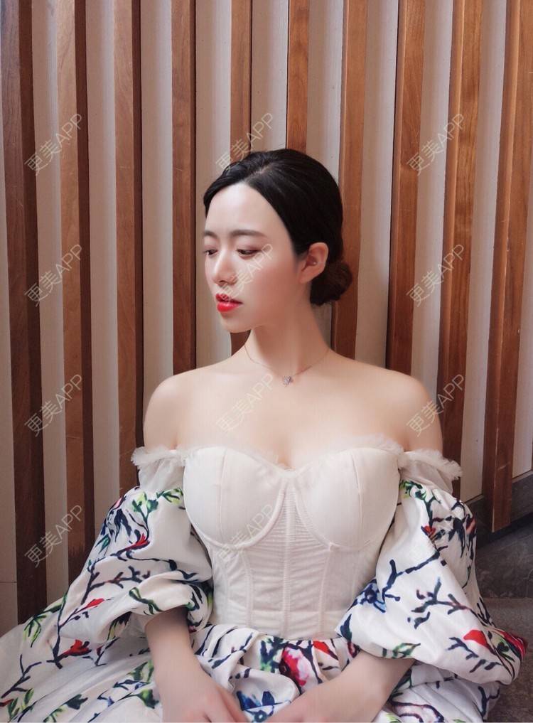 更美 - 倩倩吖的自体脂肪填充泪沟经验 | 自体脂肪丰面颊 | 自体脂肪丰太阳穴 | 美白嫩肤 | 自体脂肪填充泪沟 | 自体脂肪丰苹果肌 | 武汉 | 自体脂肪全面部填充 | 自体脂肪面部填充