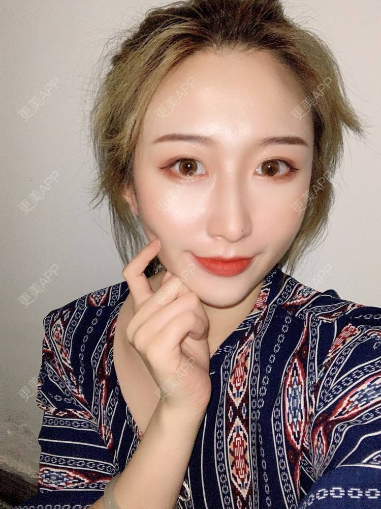 更美 - 更美用户tal2IBhSOE的埋线提升经验 | 埋线提升 | 胶原蛋白改善法令纹 | 射频提升 | 郑州