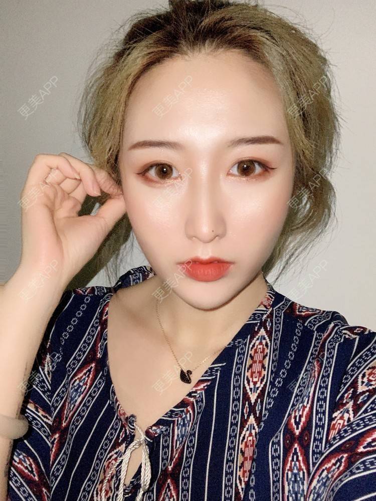 更美 - 更美用户tal2IBhSOE的埋线提升经验 | 埋线提升 | 胶原蛋白改善法令纹 | 射频提升 | 郑州