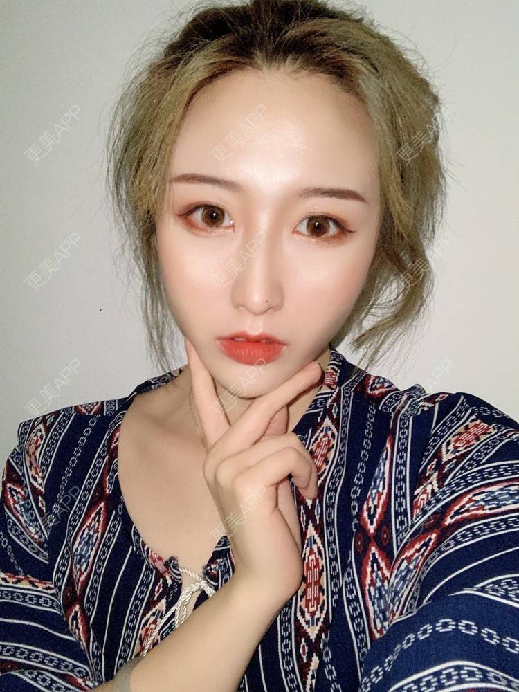 更美 - 更美用户tal2IBhSOE的埋线提升经验 | 埋线提升 | 胶原蛋白改善法令纹 | 射频提升 | 郑州