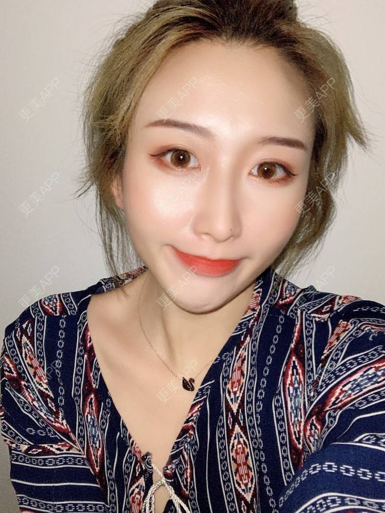更美 - 更美用户tal2IBhSOE的埋线提升经验 | 埋线提升 | 胶原蛋白改善法令纹 | 射频提升 | 郑州