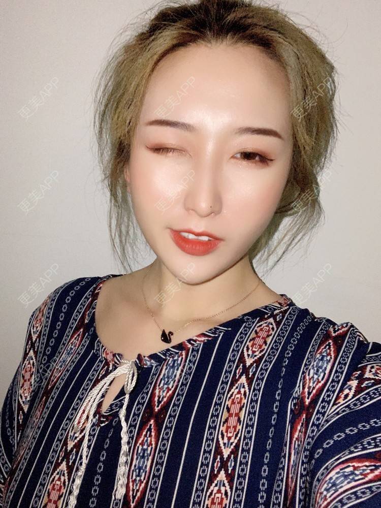 更美 - 更美用户tal2IBhSOE的埋线提升经验 | 埋线提升 | 胶原蛋白改善法令纹 | 射频提升 | 郑州