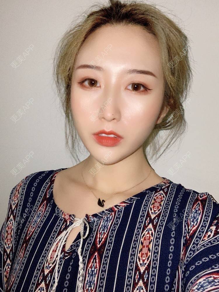 更美 - 更美用户tal2IBhSOE的埋线提升经验 | 埋线提升 | 胶原蛋白改善法令纹 | 射频提升 | 郑州