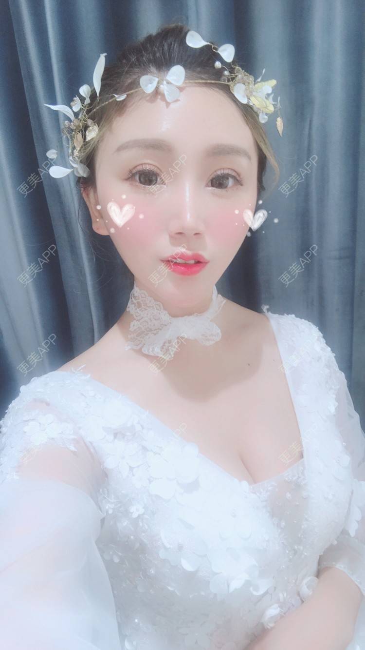 更美 - Bobbyya🌊的肋软骨隆鼻经验 | 肋软骨隆鼻 | 武汉