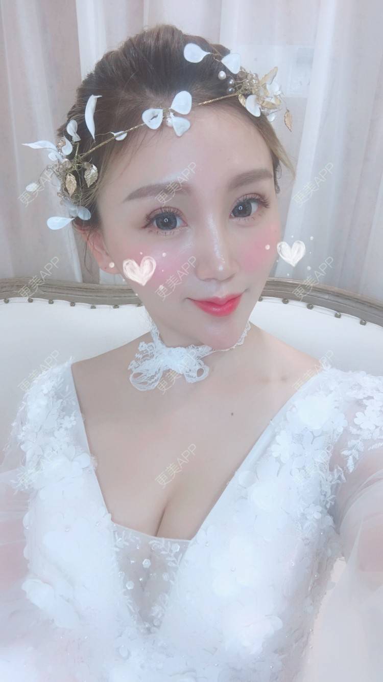 更美 - Bobbyya🌊的肋软骨隆鼻经验 | 肋软骨隆鼻 | 武汉