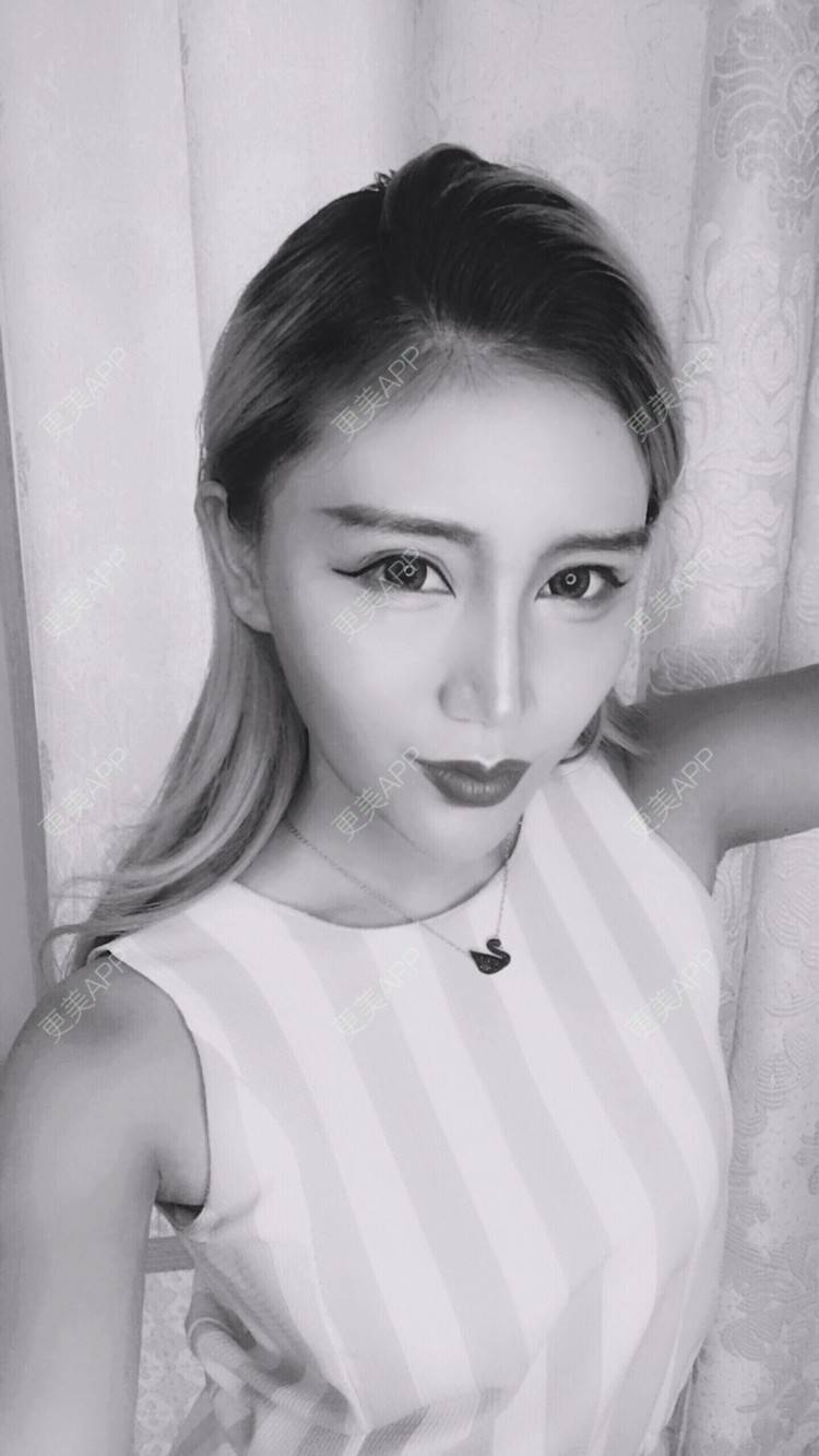 更美 - Bobbyya🌊的肋软骨隆鼻经验 | 肋软骨隆鼻 | 武汉