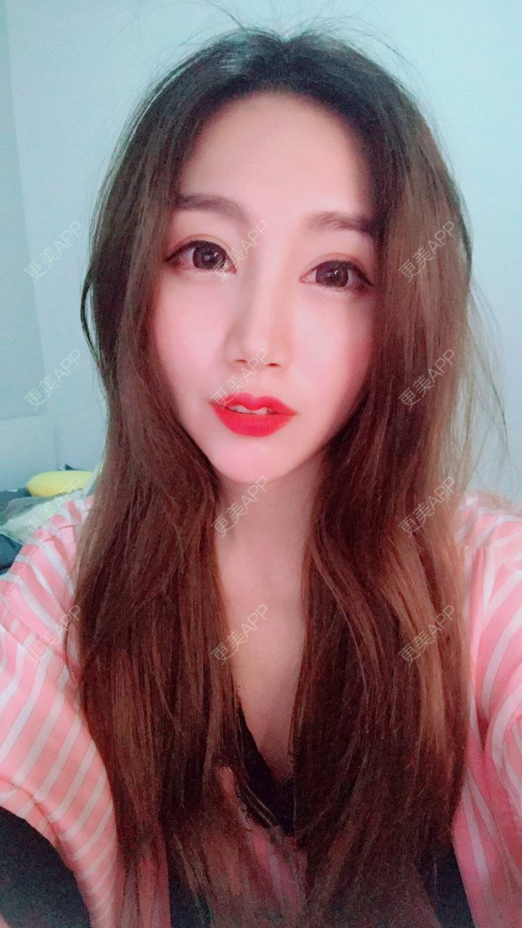 更美 - Bobbyya🌊的肋软骨隆鼻经验 | 肋软骨隆鼻 | 武汉