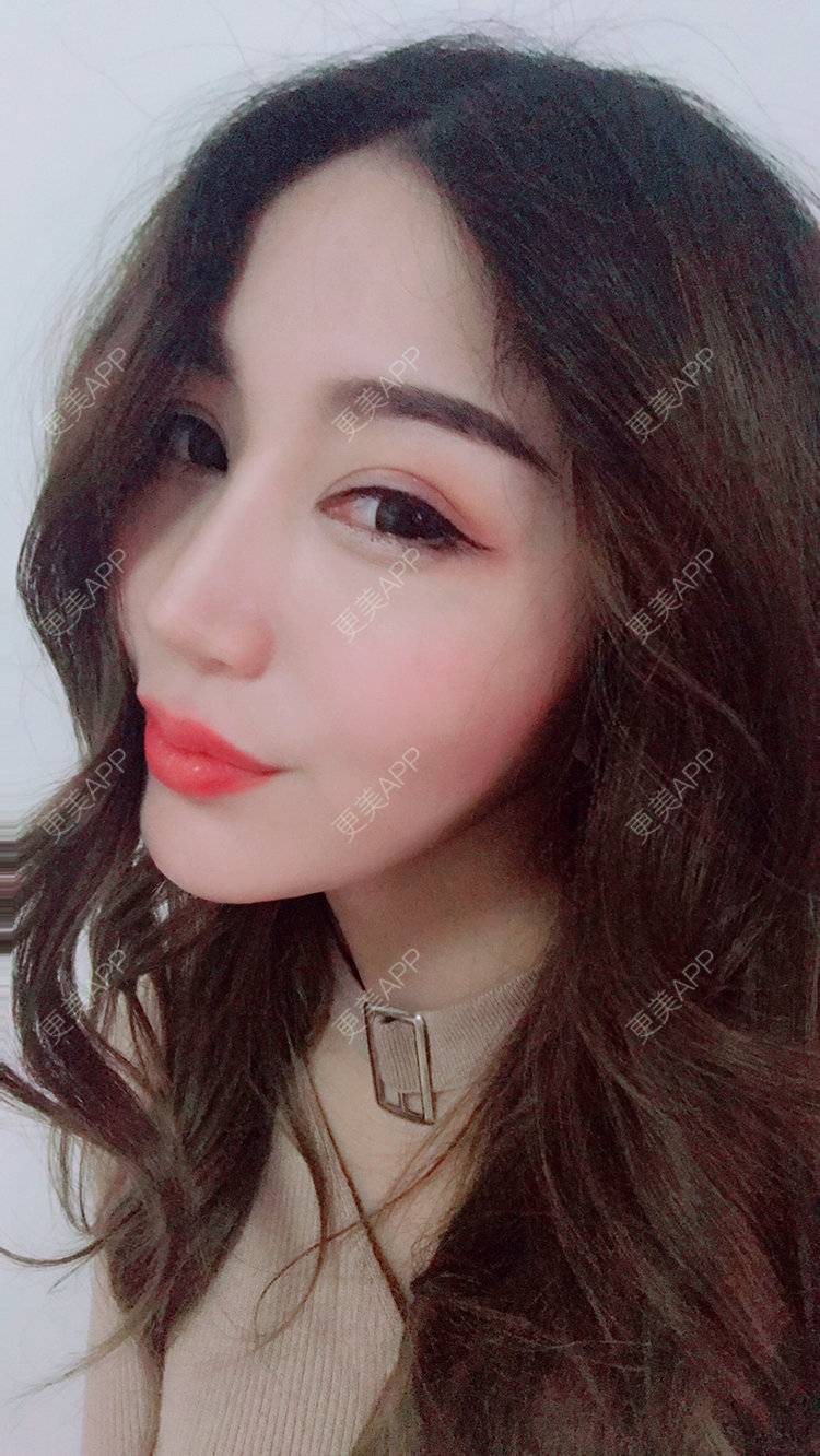 更美 - Bobbyya🌊的肋软骨隆鼻经验 | 肋软骨隆鼻 | 武汉